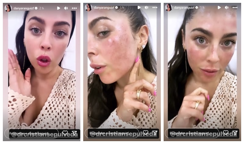 La panelista de "Zona de estrellas" mostró los avances de su cirugía estética en las historias de su cuenta oficial de Instagram.